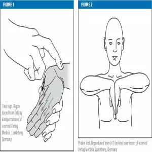 Tinel and Phalen Tests for Carpal Tunnel Syndrome